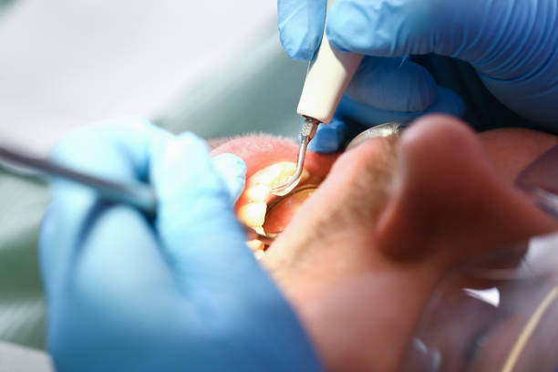 Best Emergency Wisdom Teeth Removal in Ashton Sandy Spring, MD